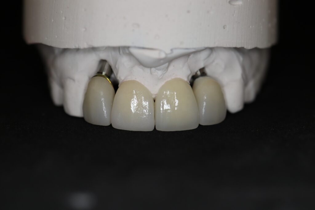 изготовление протеза