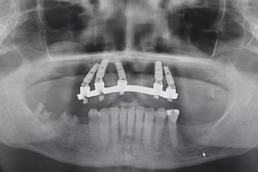 результат тотальной имплантации