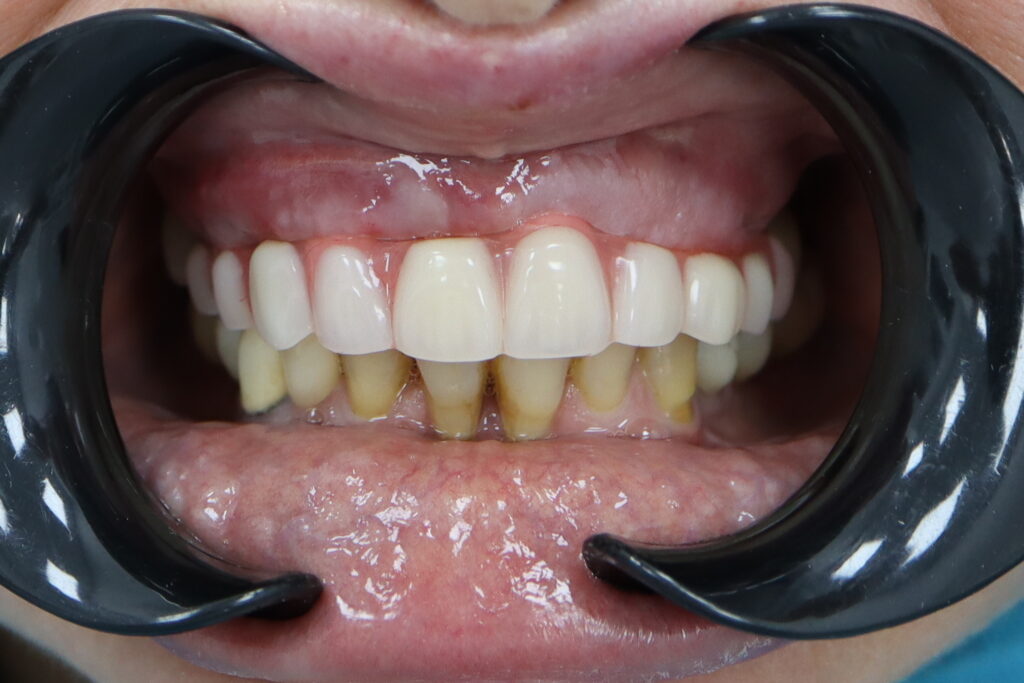 результат имплантации