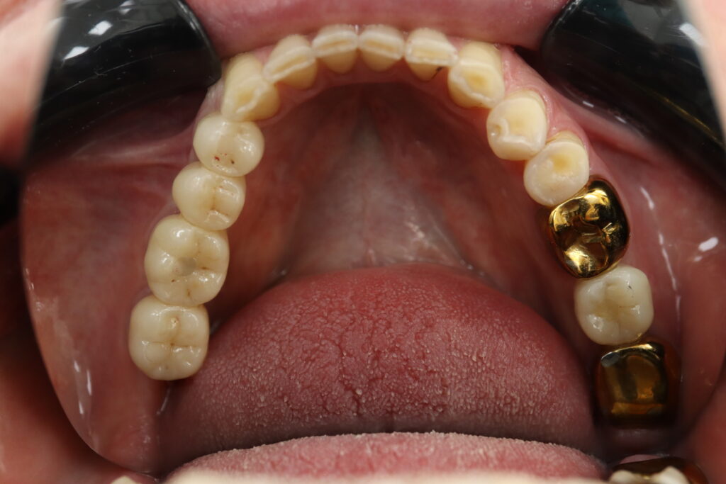 результат имплантации Megagen Anyone