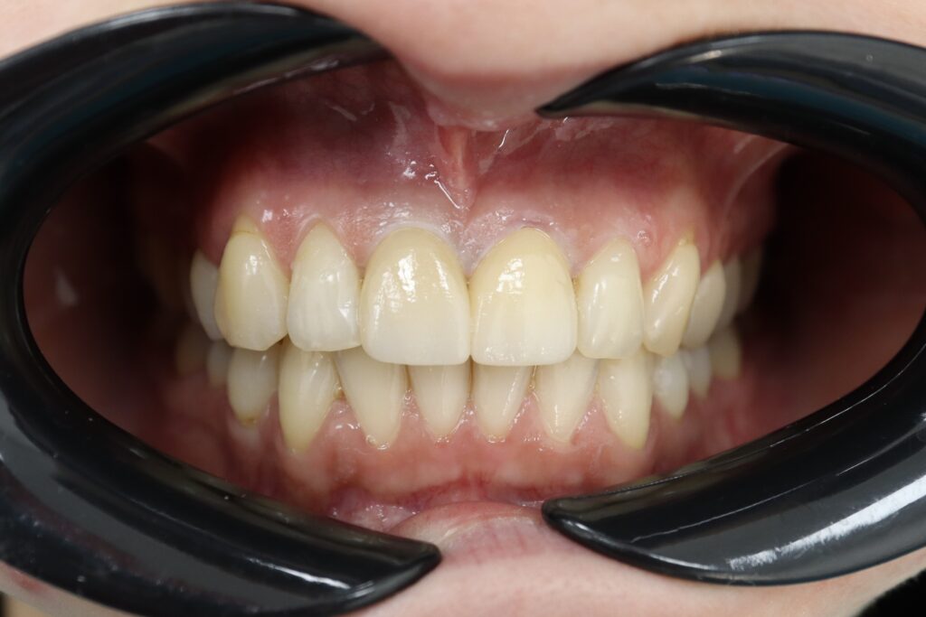 Протезирование двух центральных резцов циркониевыми коронками