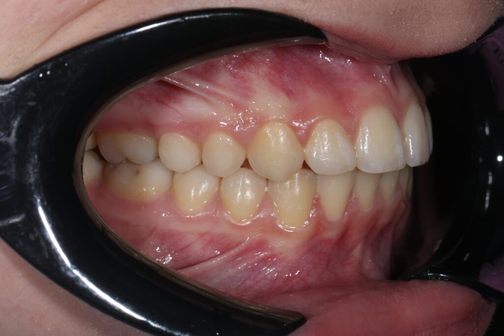 результат лечения брекет-системой