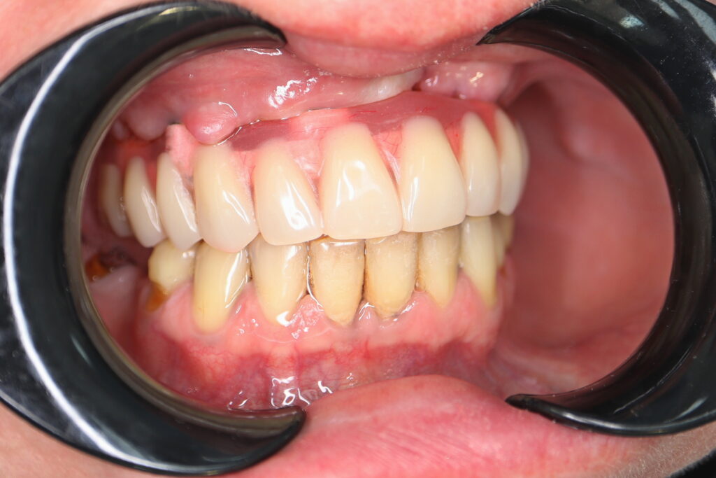 результат тотальной имплантации