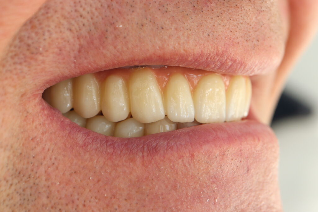 результат имплантации Megagen Anyone