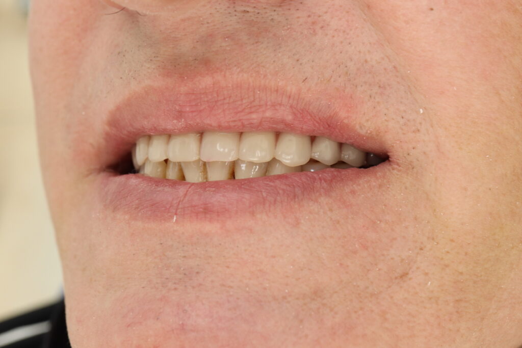 результат протезирования