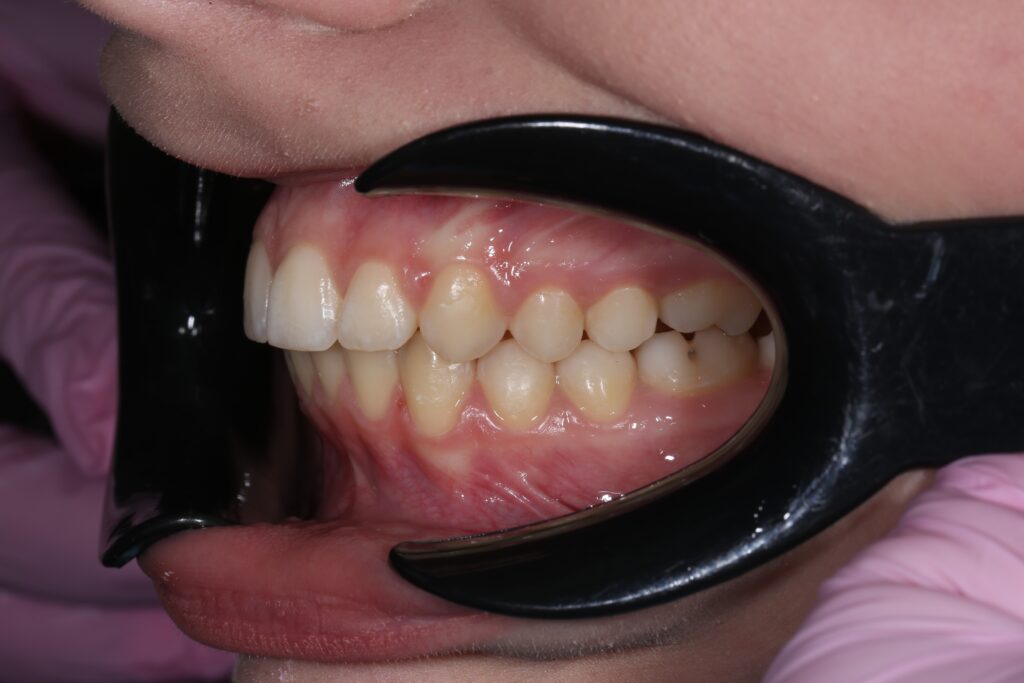 результат лечения брекет-системой