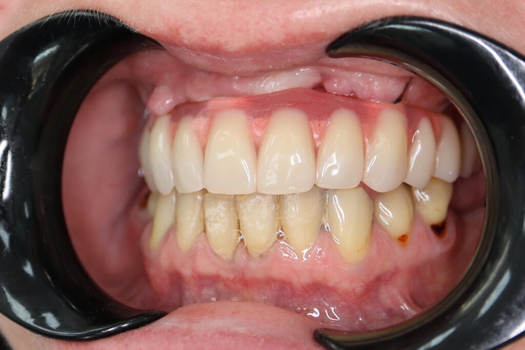 результат тотальной имплантации