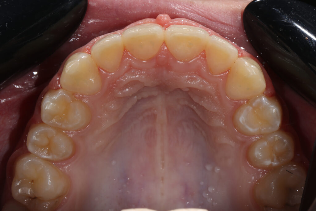 результат ортодонтического лечения