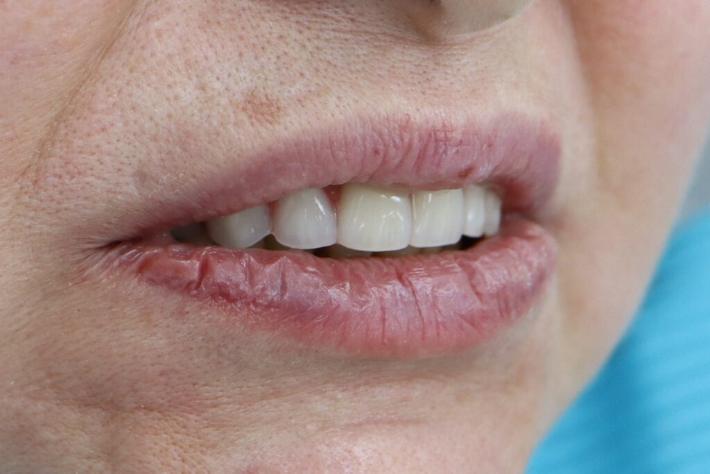 All-on-5 (Straumann BLT)