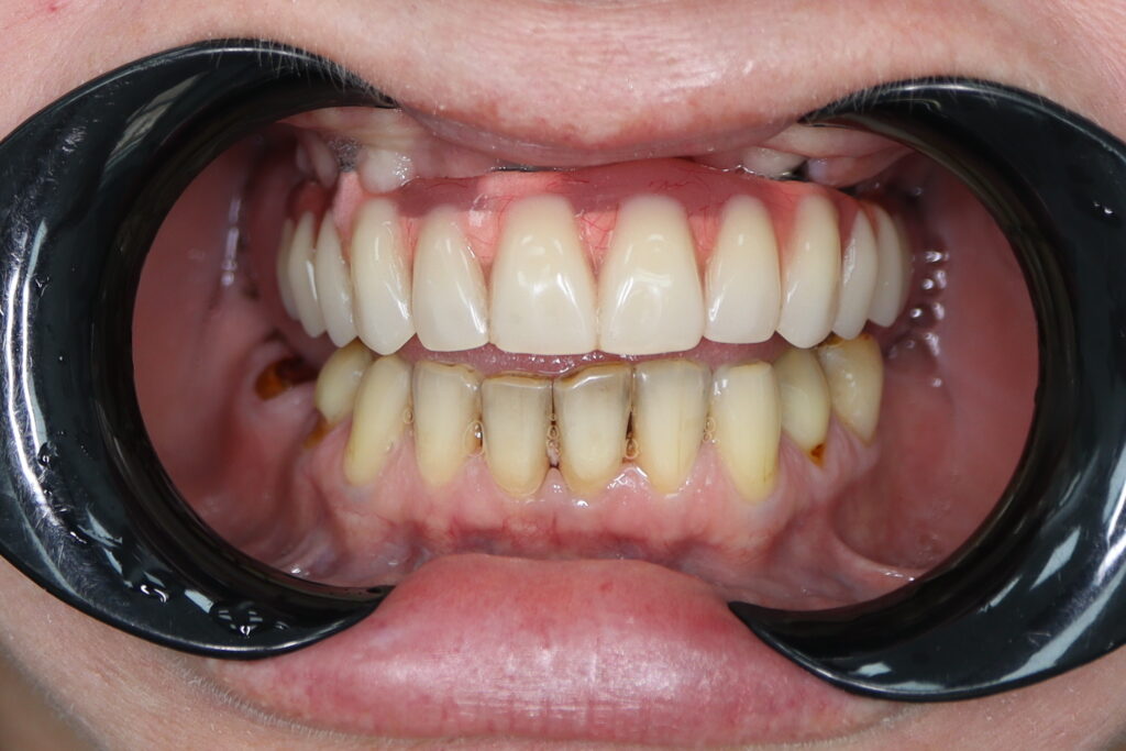 результат тотальной имплантации