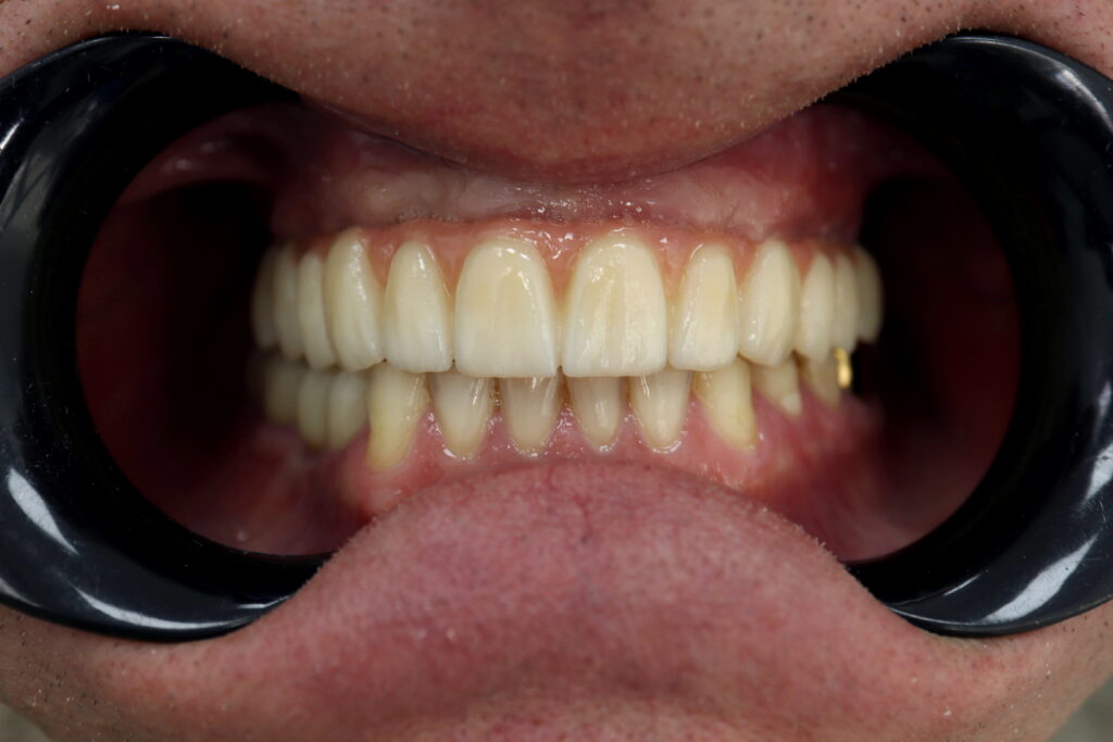 результат имплантации Megagen Anyone