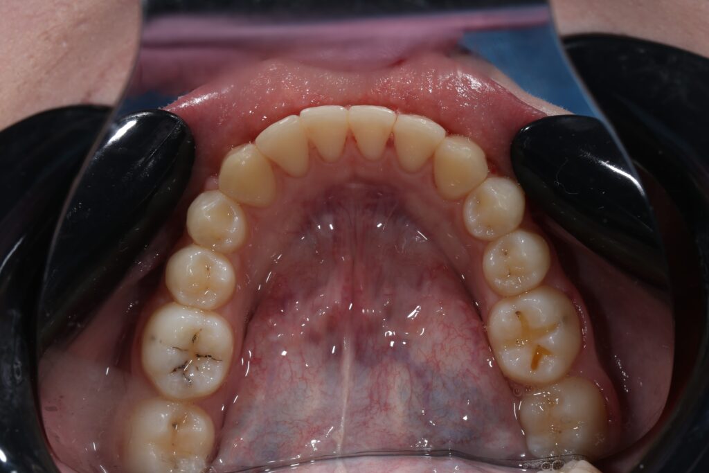 результат лечения брекет-системой