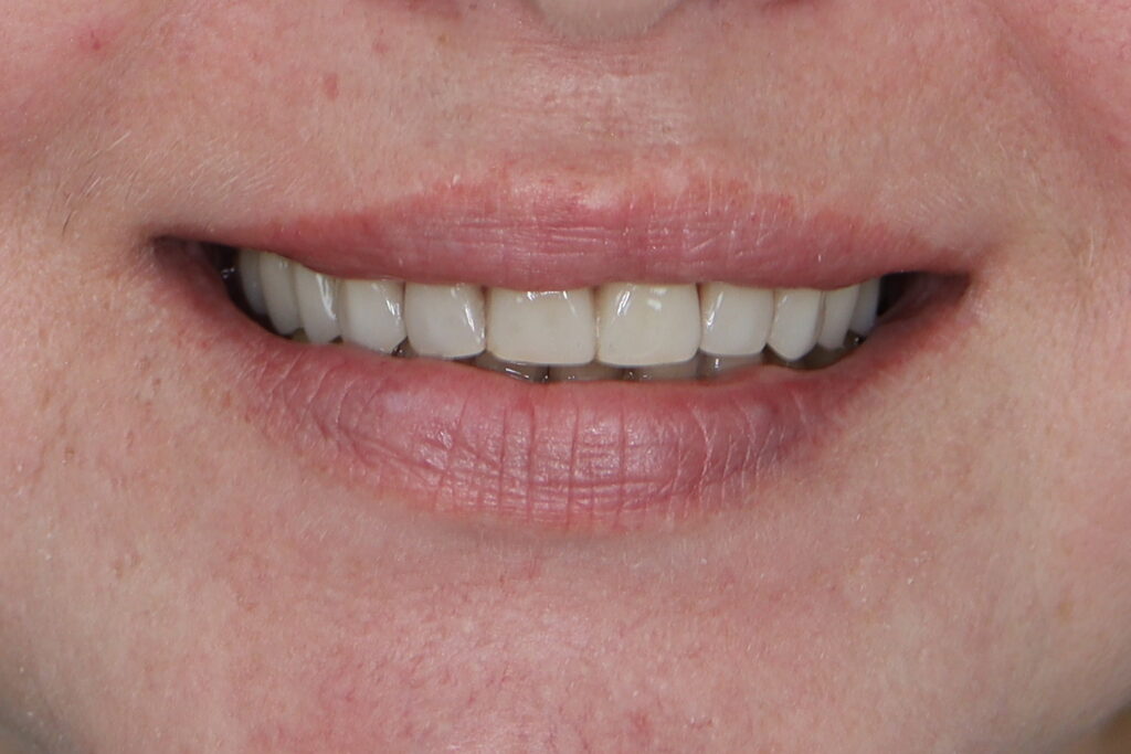 Тотальная имплантация (Megagen Anyone)