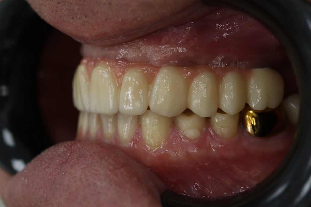 результат имплантации Megagen Anyone