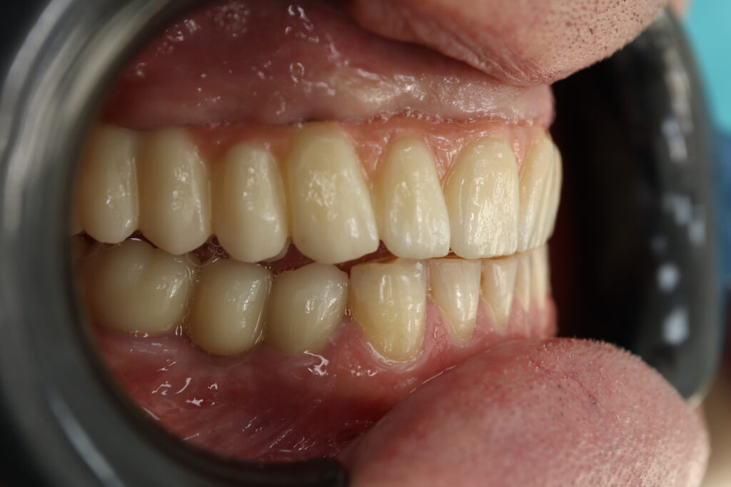 результат имплантации Megagen Anyone