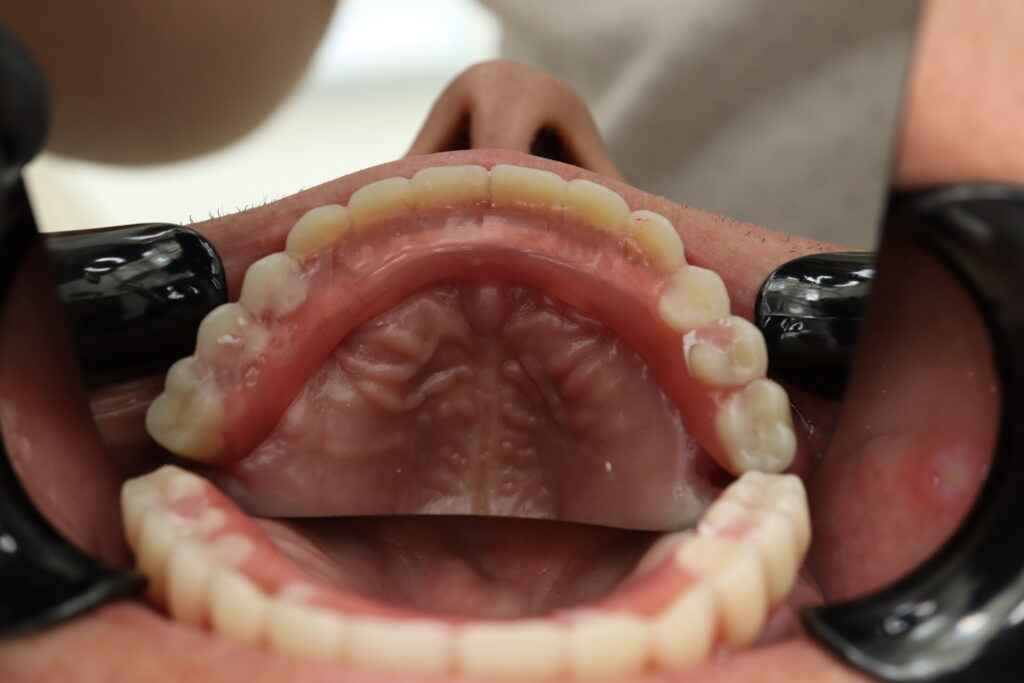 результат протезирования