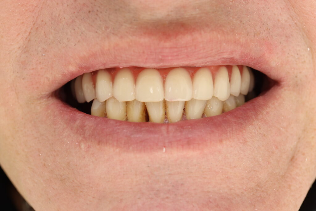 All-on-4 (Megagen AnyOne)