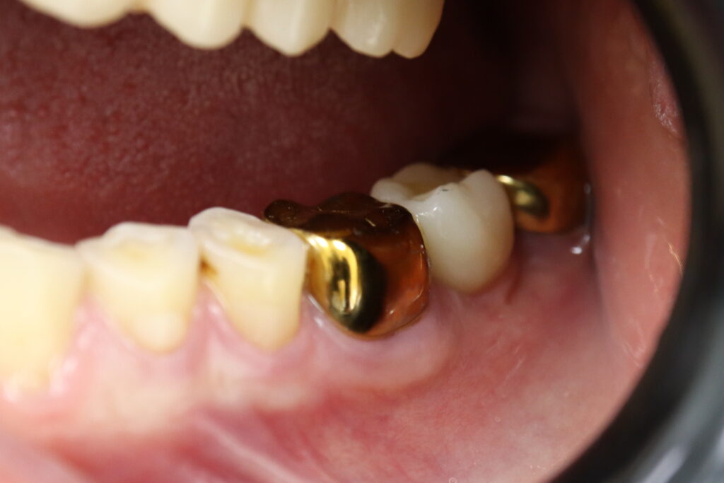 результат имплантации Megagen Anyone