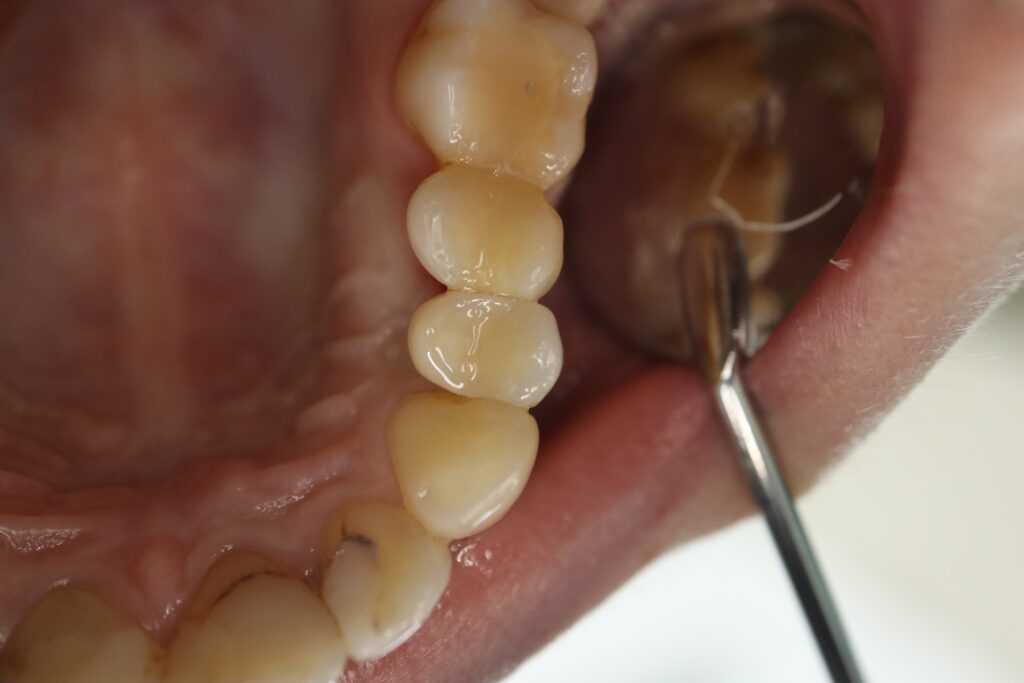 результат протезирования