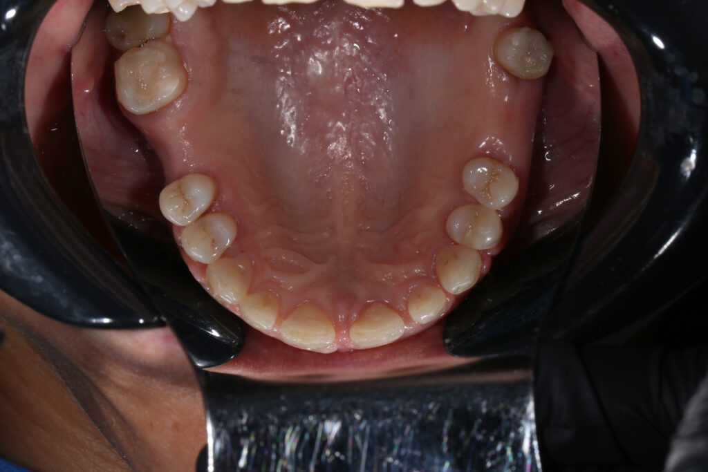 Результат лечения брекет-системой