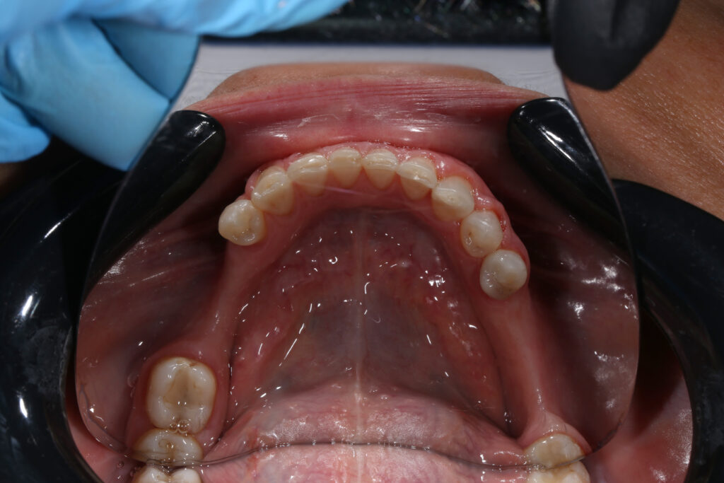 Результат лечения брекет-системой