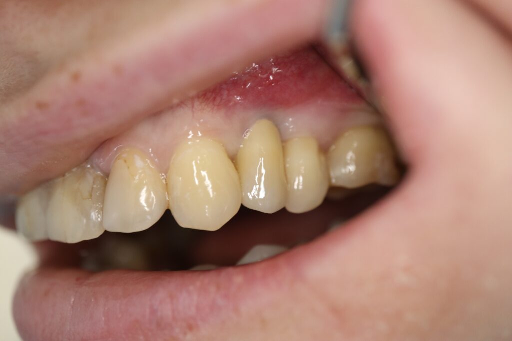 результат протезирования