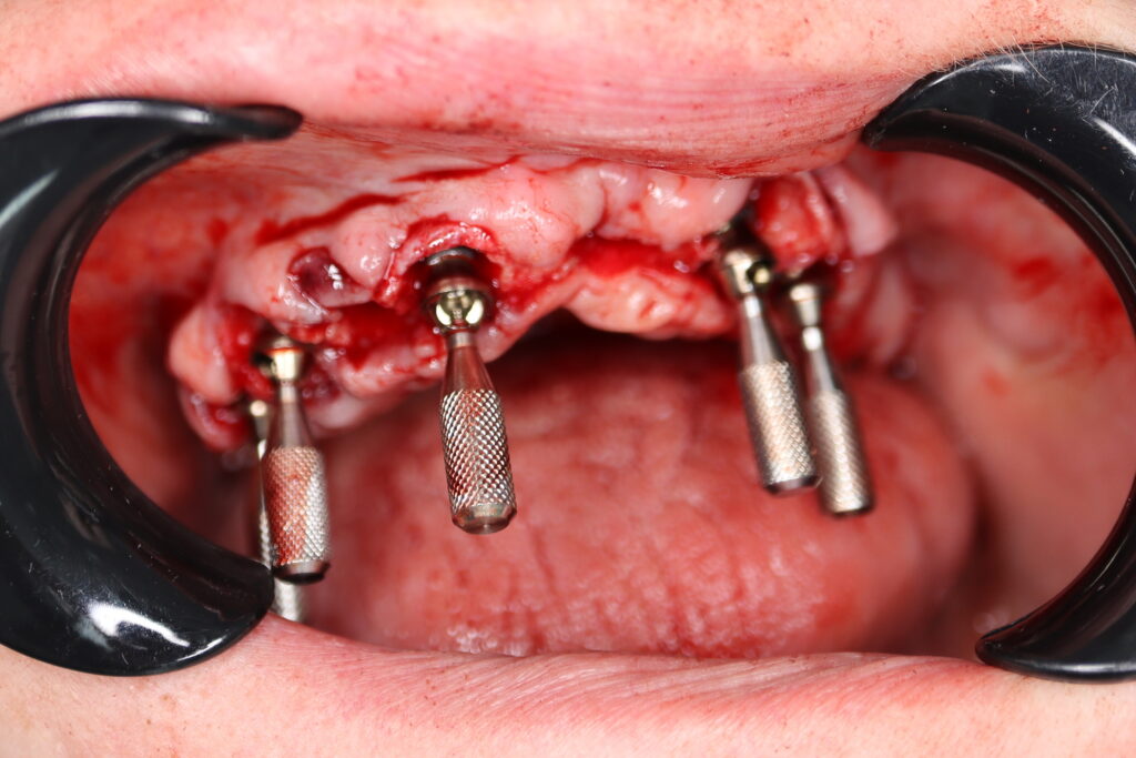 процесс тотальной имплантации