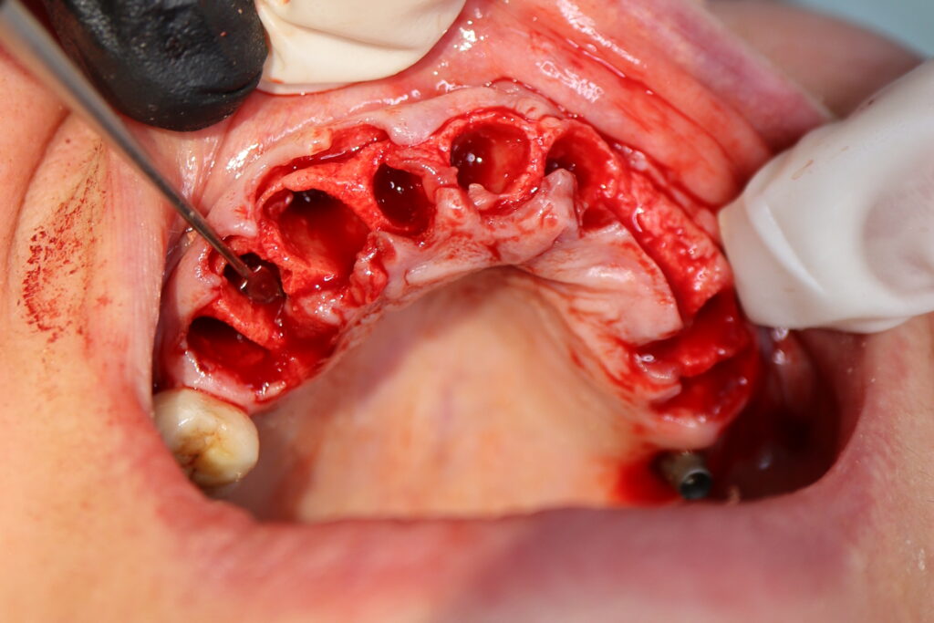 процесс имплантации