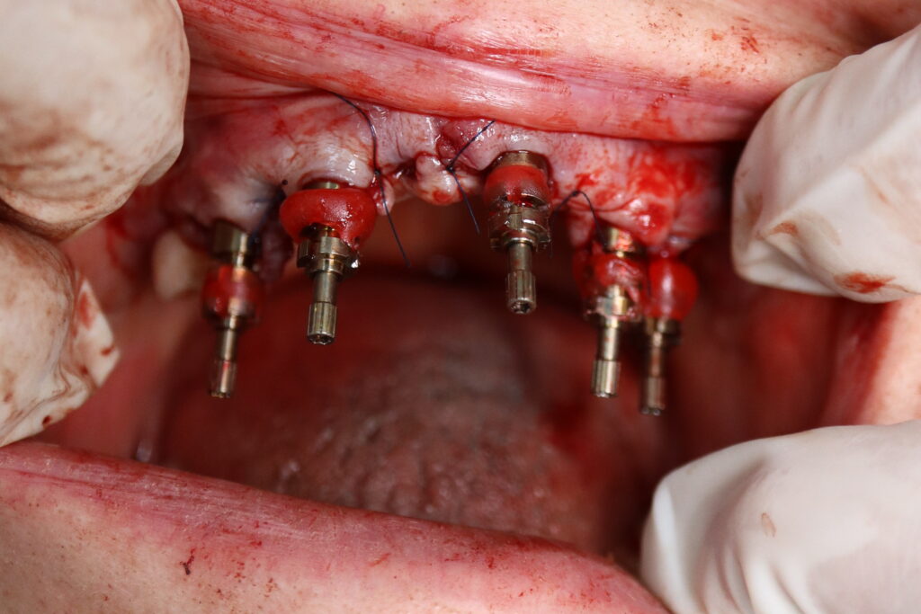 процесс имплантации