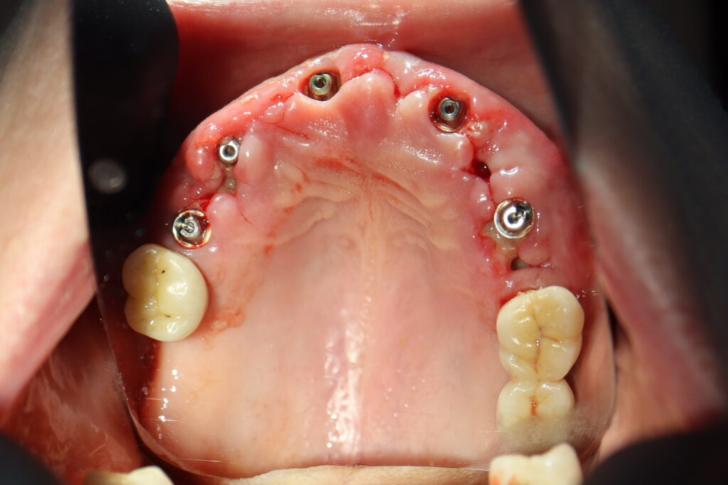 процесс имплантации