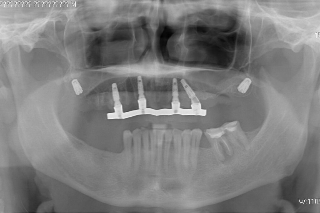 результат протезирования