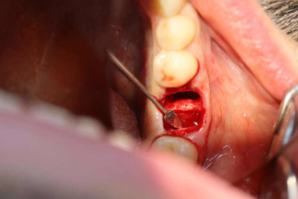 процедура имплантации