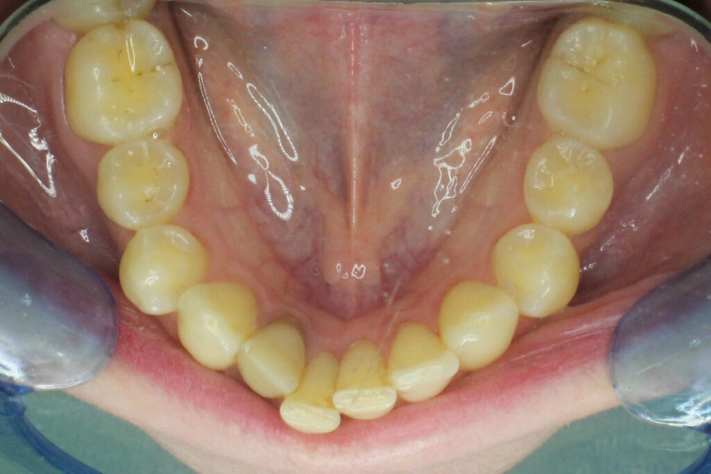 пациент до брекет-системы