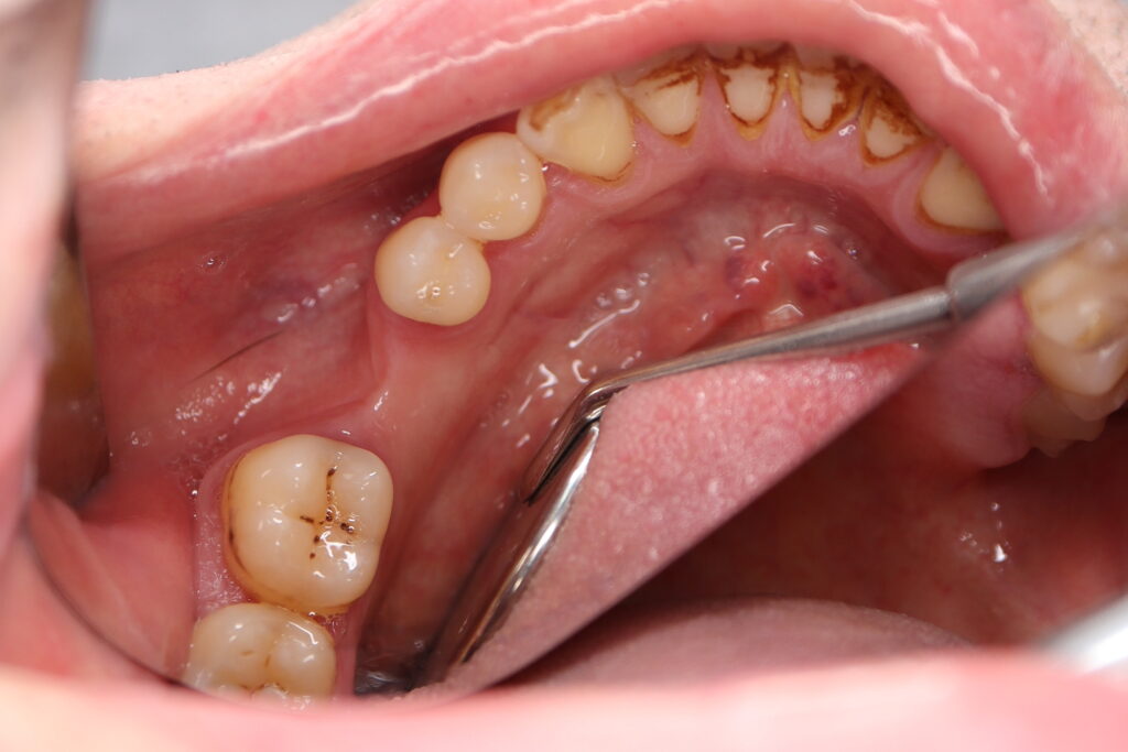 пациент до имплантации