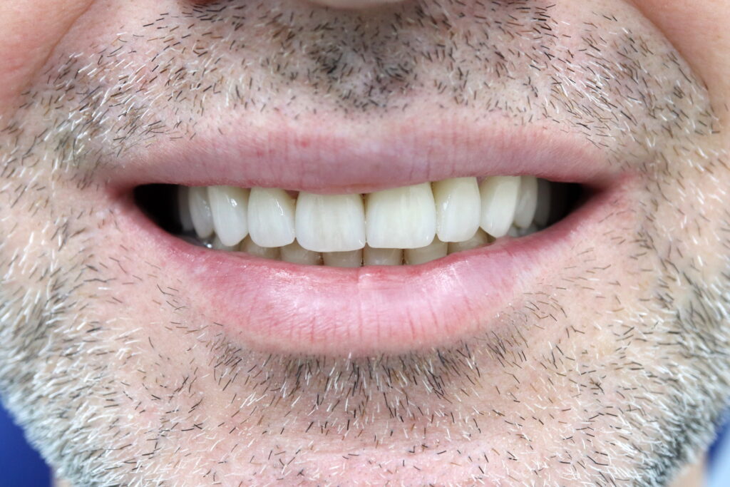 результат протезирования