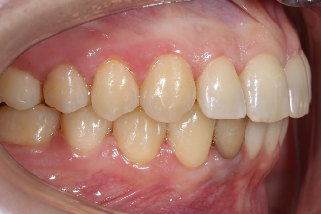 пациент после лечения брекет-системой