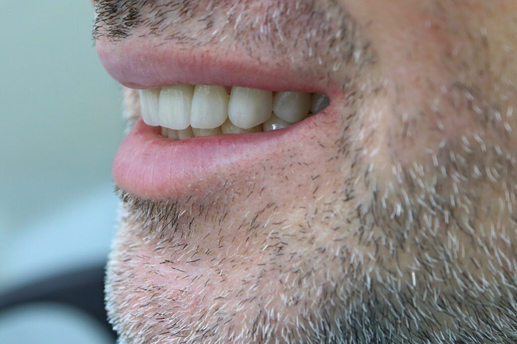 результат протезирования