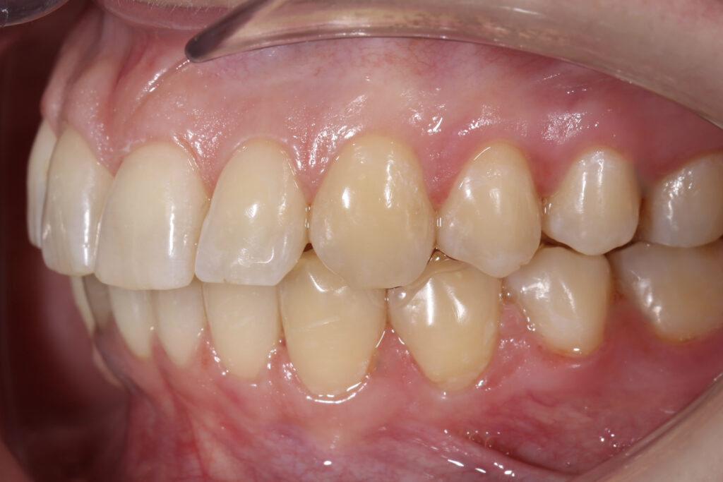 пациент после лечения брекет-системой