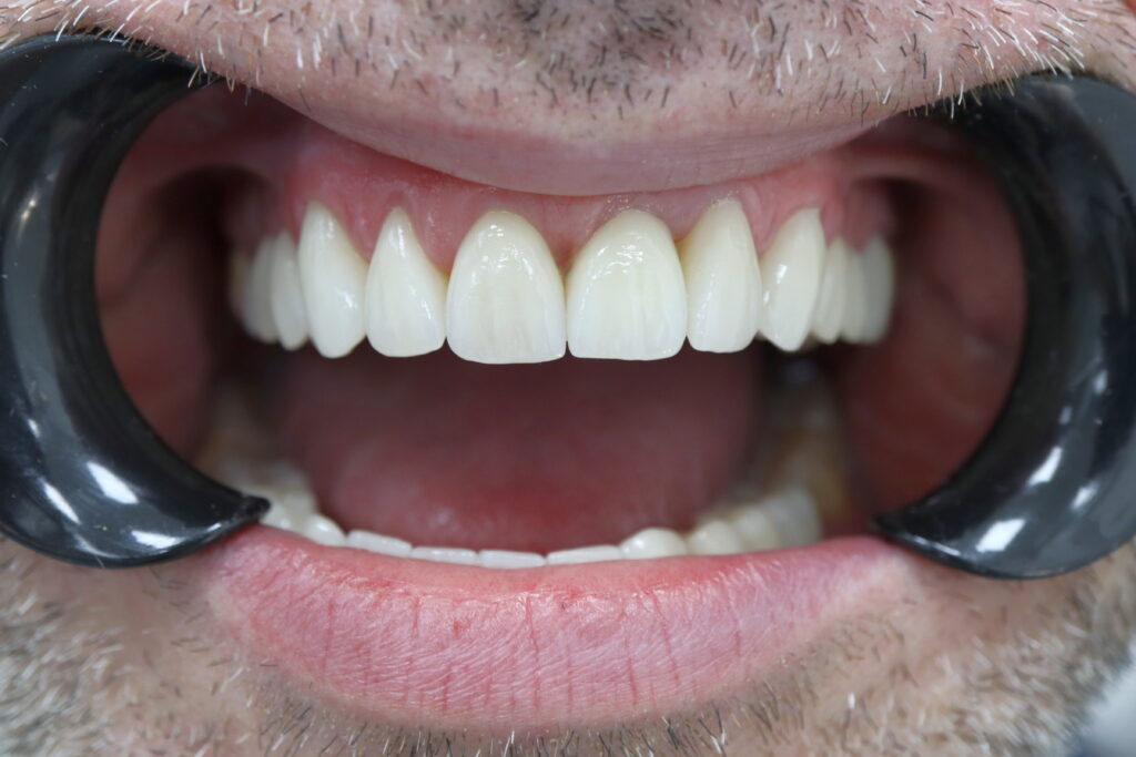 результат протезирования