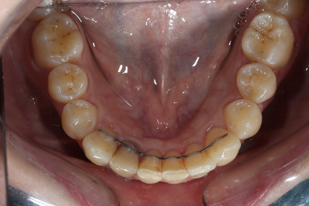 пациент после лечения брекет-системой
