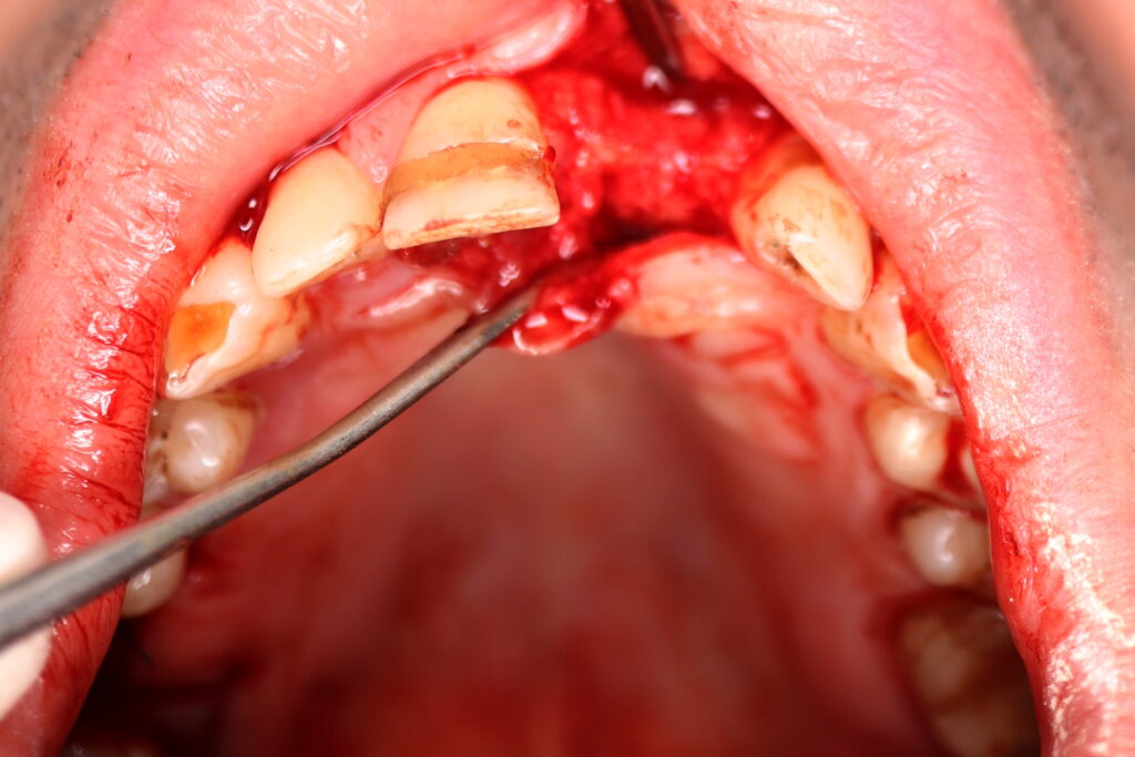 хирургический этап