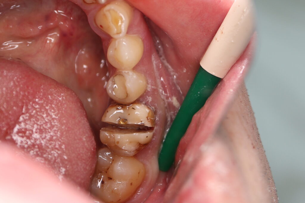 хирургический этап