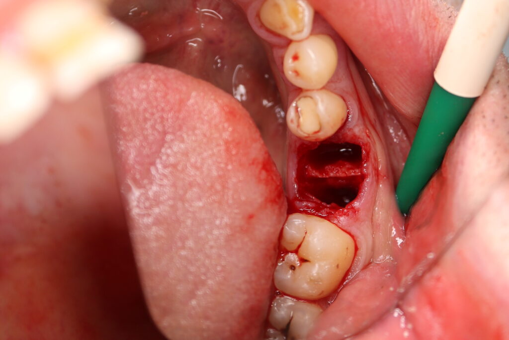 хирургический этап