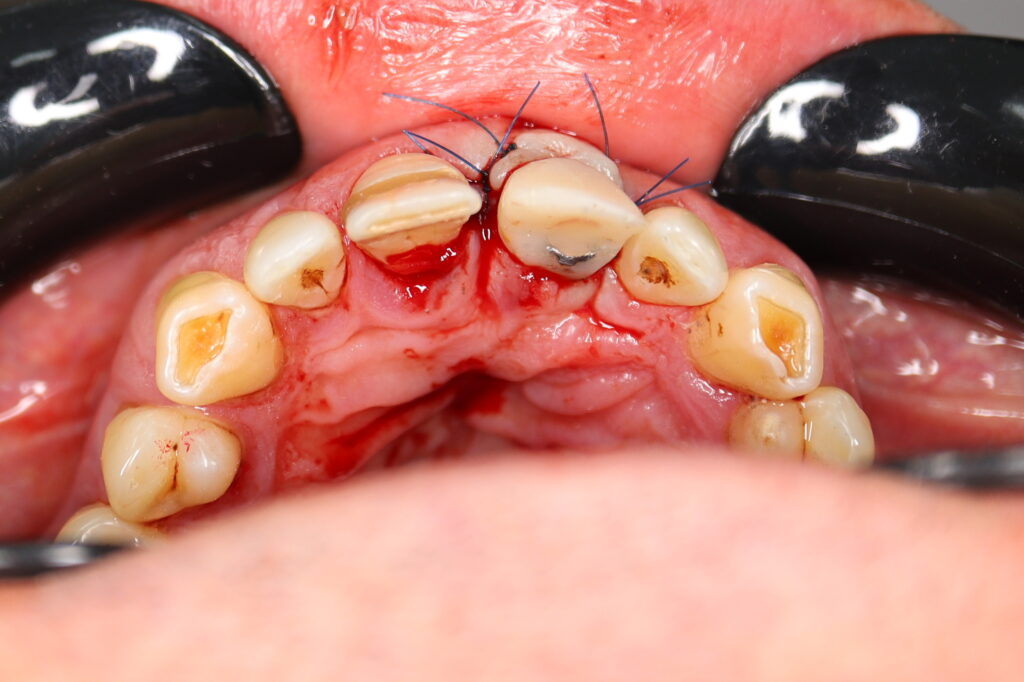 Результаты хирургического этапа