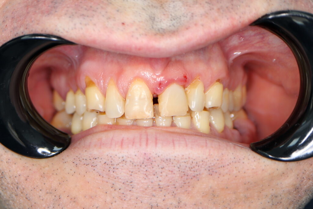 Результаты хирургического этапа