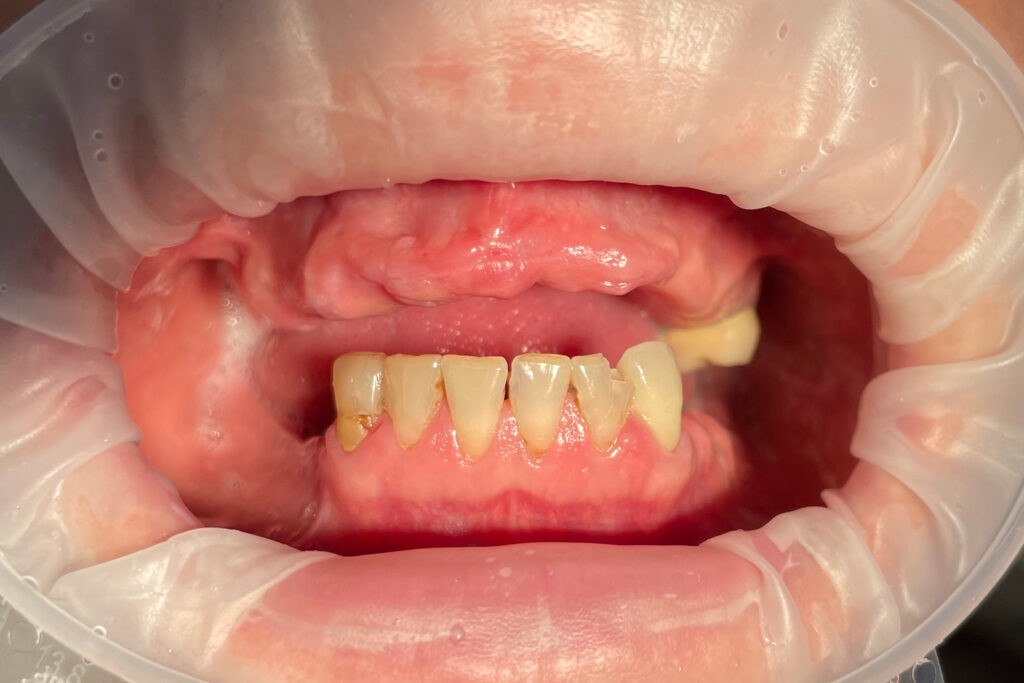 пациент до имплантации