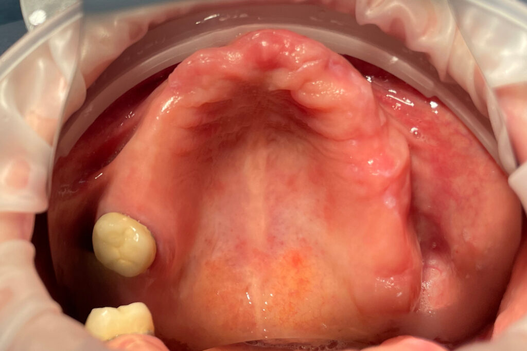 пациент до имплантации