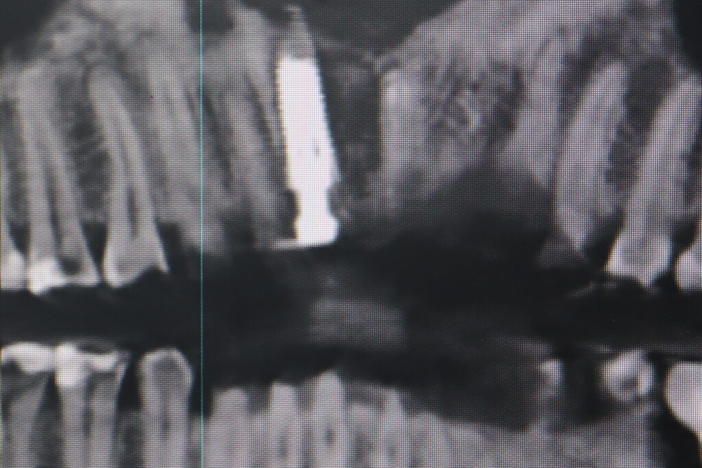 результат имплантации