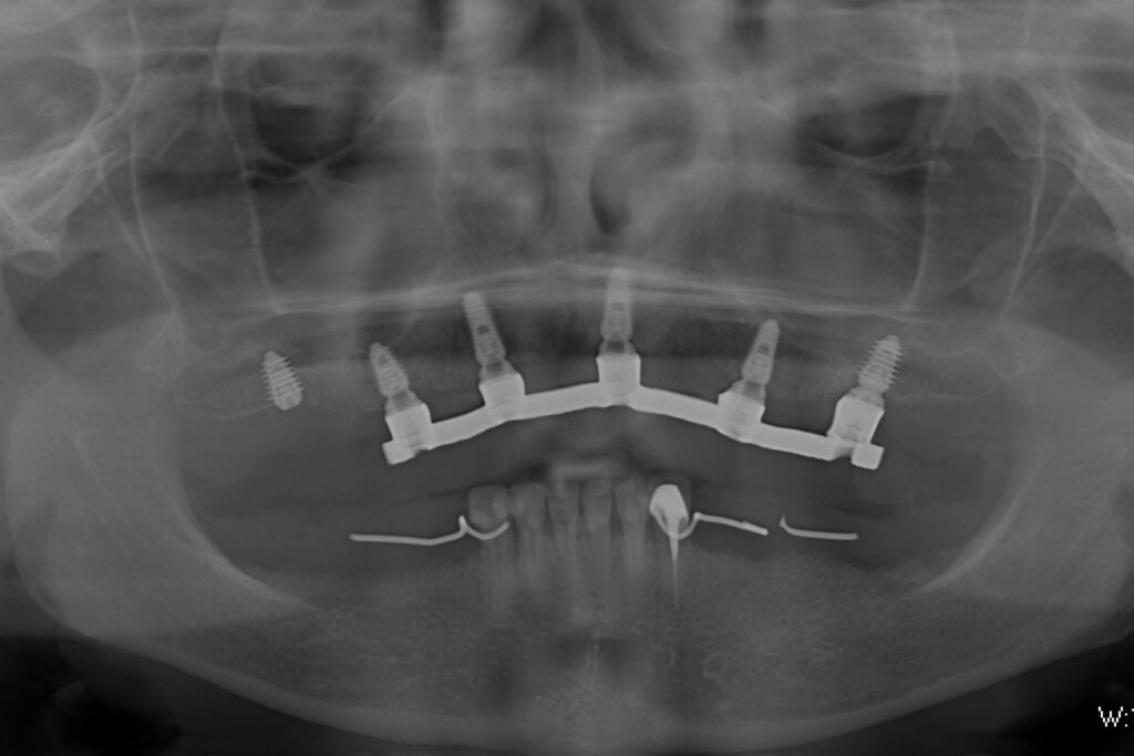 Результат имплантации