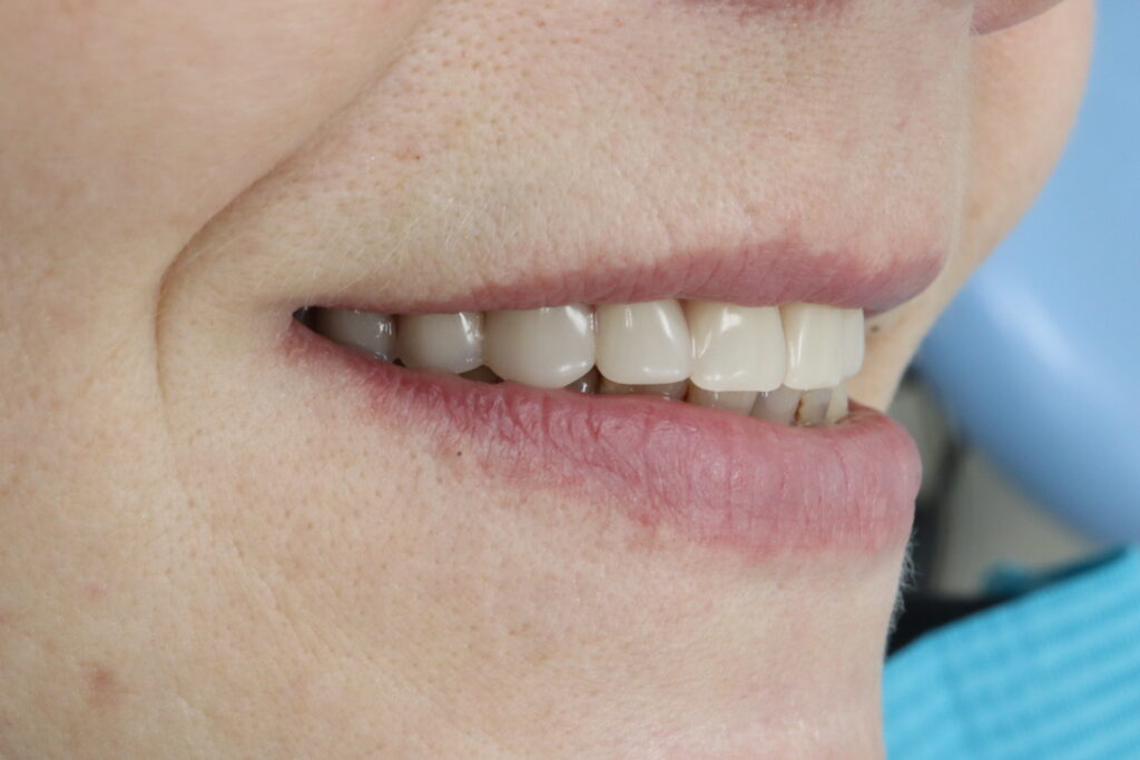 Результат имплантации